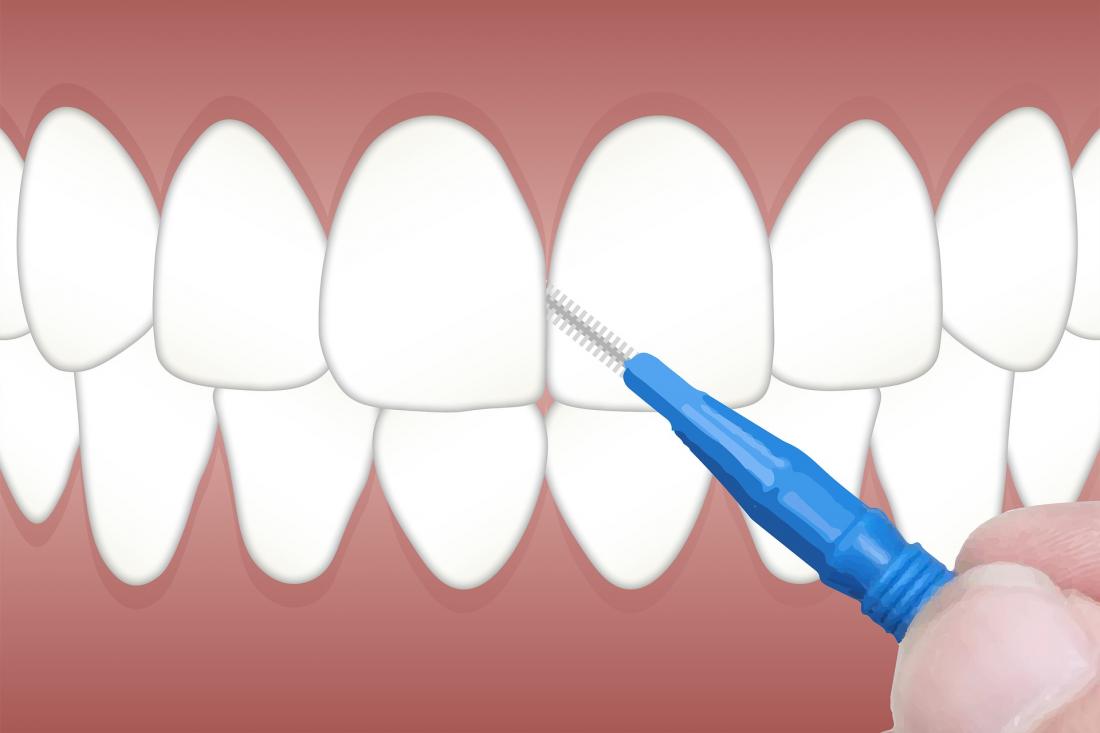 How Long Does A Dental Cleaning Procedure Take?