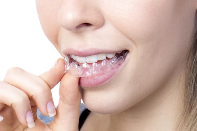 Things To Consider Before Getting Clear Braces Service